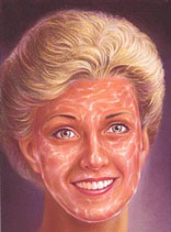 Chemical Peel 4 chemical peel 3