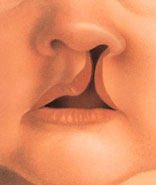 cleft lip 1