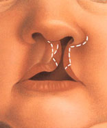 cleft lip 2