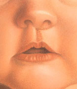 cleft lip 4