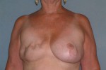 Breast Reconstruction Delaware