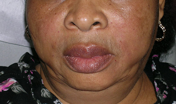 Dermal Fillers Before and After Photos