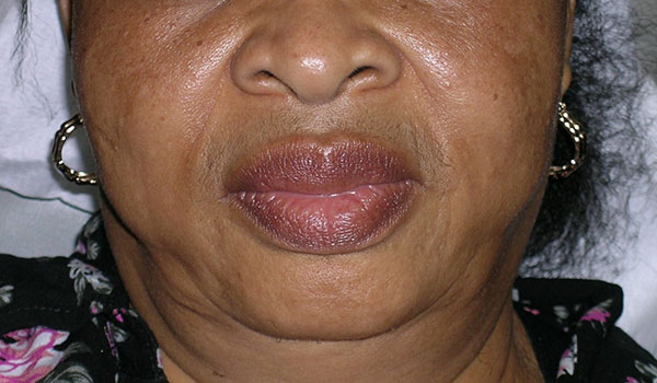 Dermal Fillers Before and After Photos